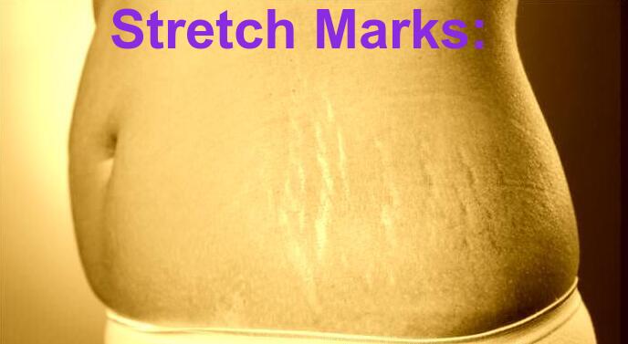 Remove Stretch Marks
